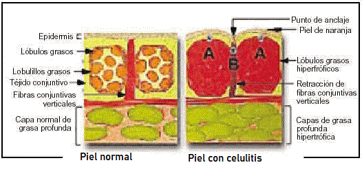 que-es-la-celulitis